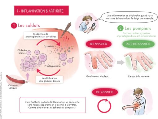 L’arthrite Juvénile Idiopathique ( AJI) (Fiches) – Image 3